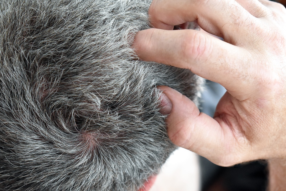 Irritatie van de hoofdhuid