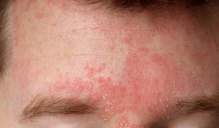 Wat is seborroïsch eczeem? Seborroïsch eczeem valt onder de huidziekten en is een specifieke vorm van eczeem of dermatitis.