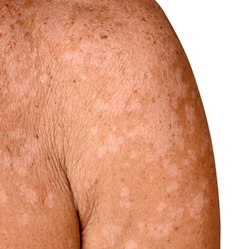 De huidziekte pytiriasis versicolor wordt veroorzaakt door de Malassezia furfur en kan dus ook met ketoconazol aangepakt worden.
