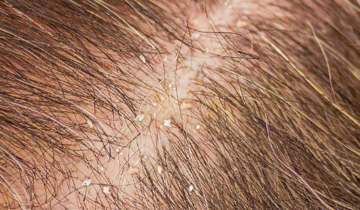 Ook op een normale hoofdhuid bevinden zich huidschilfers. 