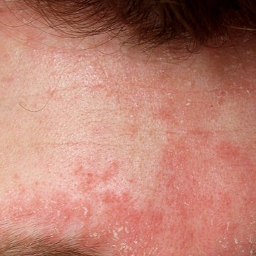 Seborroïsch eczeem ontstaat door de woekering van de schimmel Malassezia furfur.