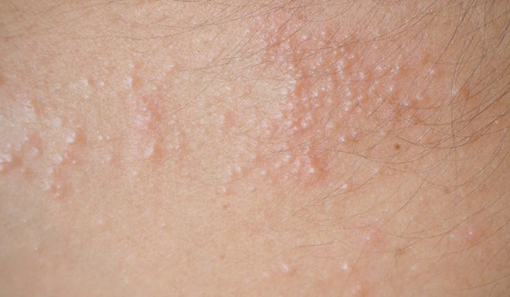 Sommige vormen van eczeem hebben als symptoom jeukende vochtblaasjes die kunnen opdrogen tot korstjes.