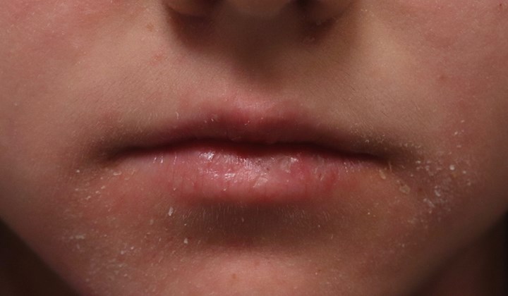 Schilfers in grote hoeveelheden kunnen wijzen op roos of seborroïsch eczeem.