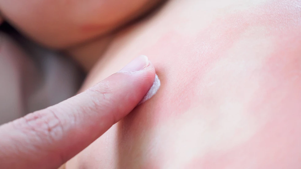 Découvrez ici comment traiter l'eczéma.