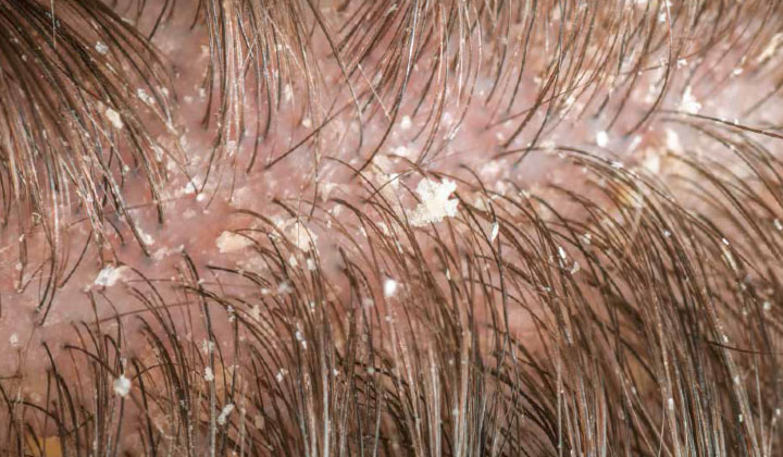 Lorsqu’ il y a environ 74% de cellules malassezia sur le cuir chevelu, on parle de pellicules.