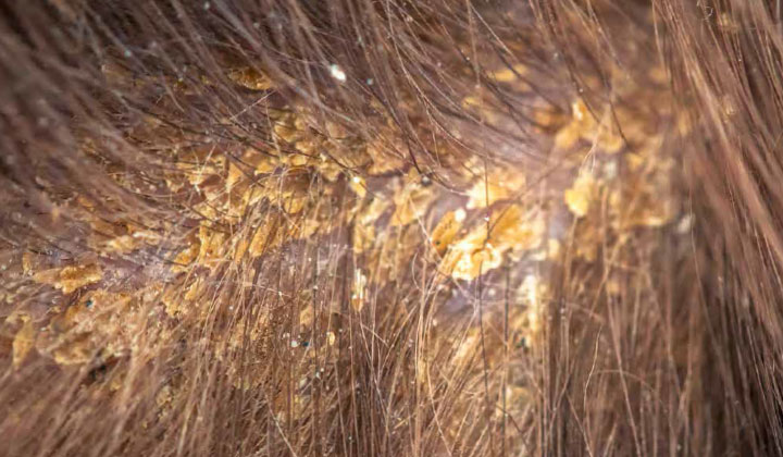 On parle d'eczéma séborrhéique lorsque les cellules Malassezia sont présentes à 83 %.