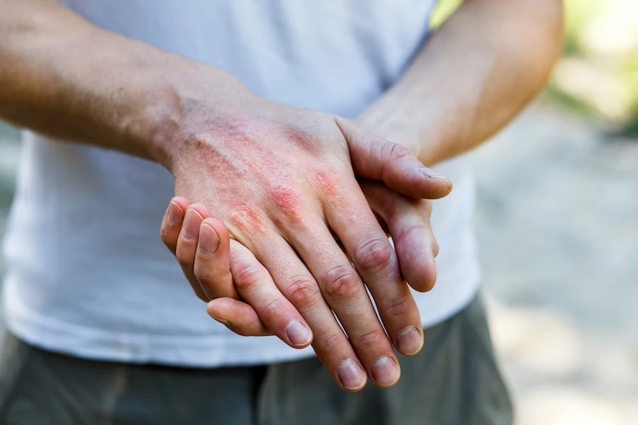 L'eczéma n'est pas contagieux car ce n'est pas un virus.