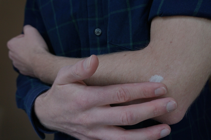 Traitez l'eczéma avec une crème hydratante