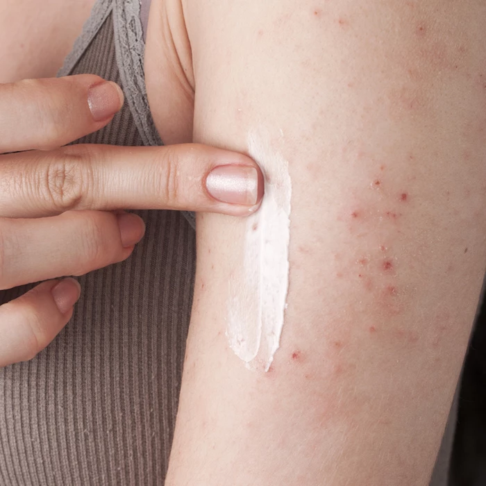 Traitez l'eczéma avec une pommade ou une crème à la cortisone