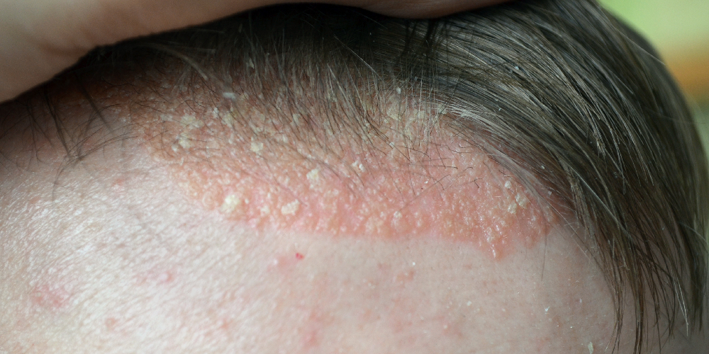 Psoriasis heeft ook rode vlekken met witte schilfering als symptoom.
